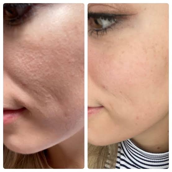 Say Goodbye to Enlarged Pores: How Microneedling Rebuilds Smooth, Flawless Skin