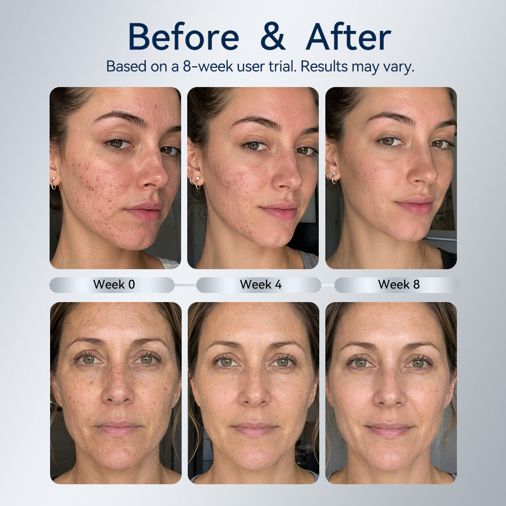 NEW Dr. Pen Micro-Infusion Skin Needling Stamp Kit (2 Month Supply)