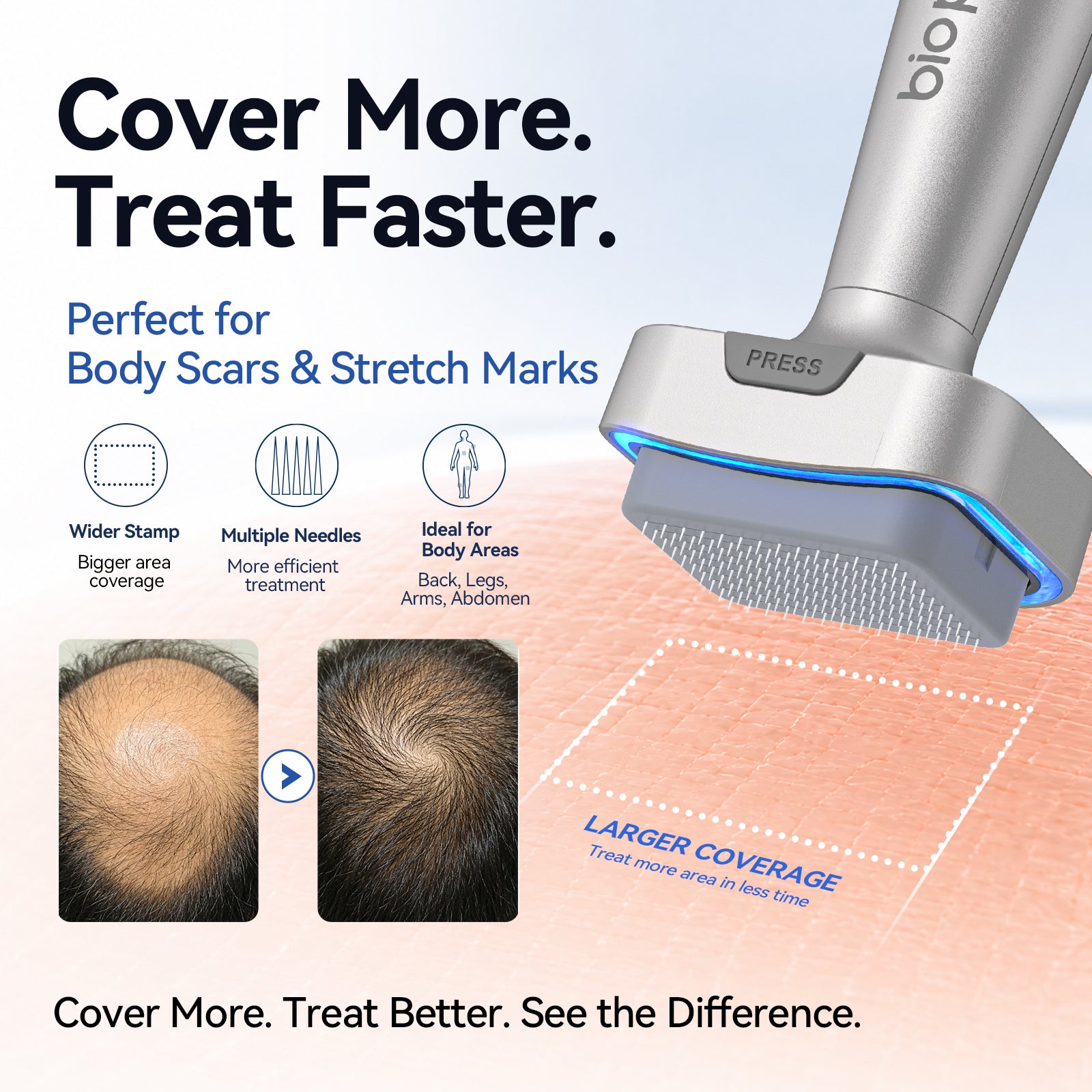 Biopen Bio 6 Hair Growth Microneedle Stamp with EMS & LED Light