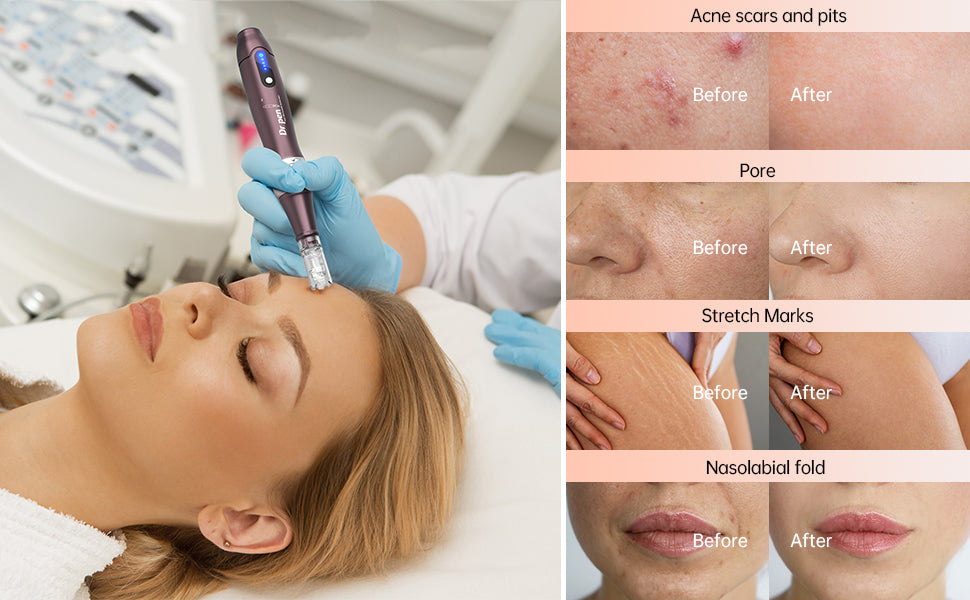 Dr. Pen A10 Dark Purple Microneedling Pen