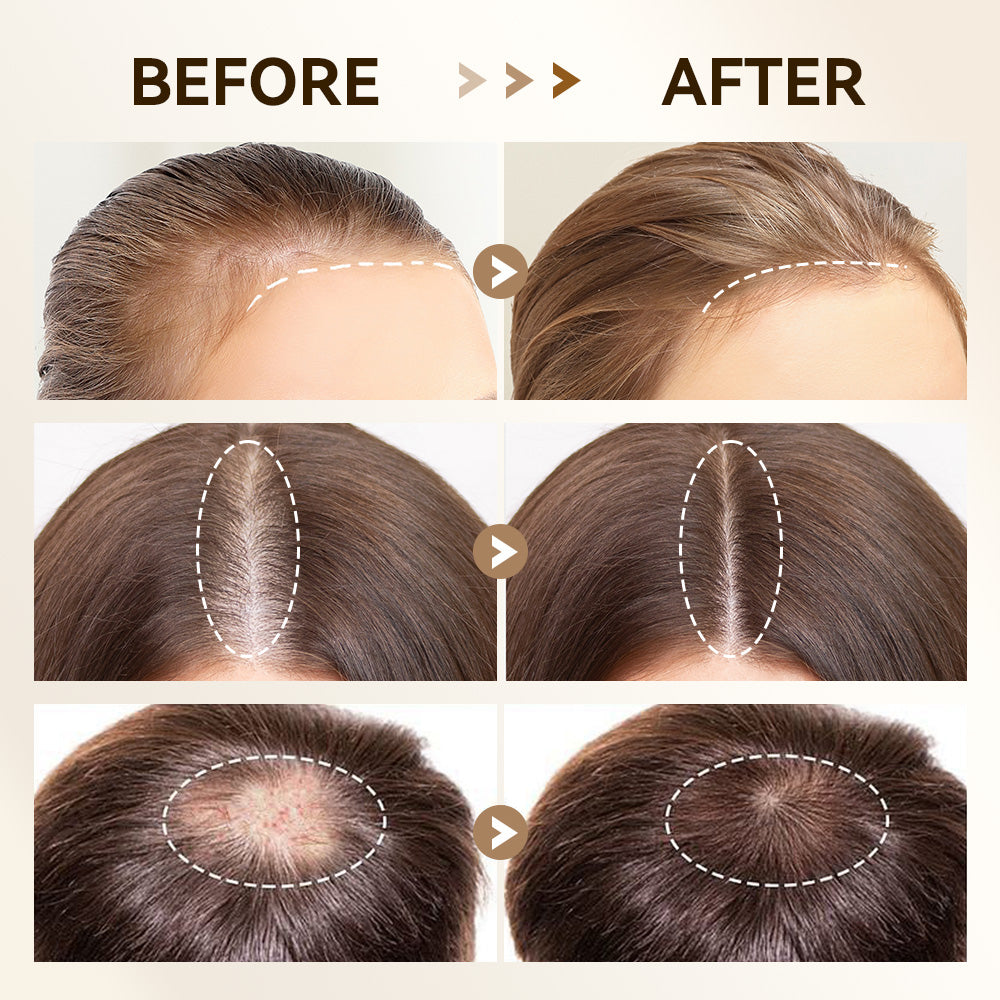 Bio 4 Adjustable Derma Stamp - Hair Growth Microneedling Tool